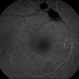 Branch Retinal Artery Occlusion - FA Branch Retinal Artery Occlusion - FA